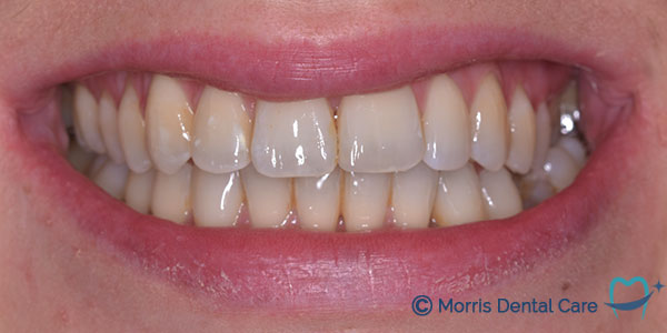 After the treatment which involved composite bonding and teeth whitening our patient's smile gave him more confidence.